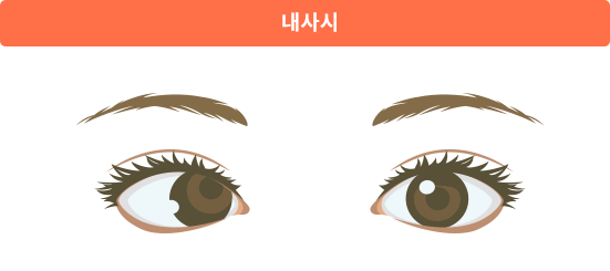 내사시