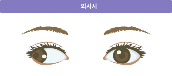 외사시