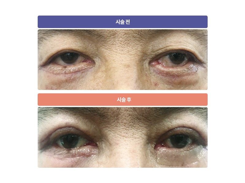 노인성 쌍꺼풀