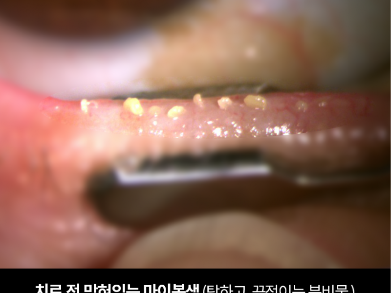 안구건조증 IPL 치료